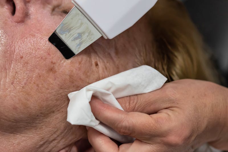 Kavitationspeeling - ©strigana - stock.adobe.com